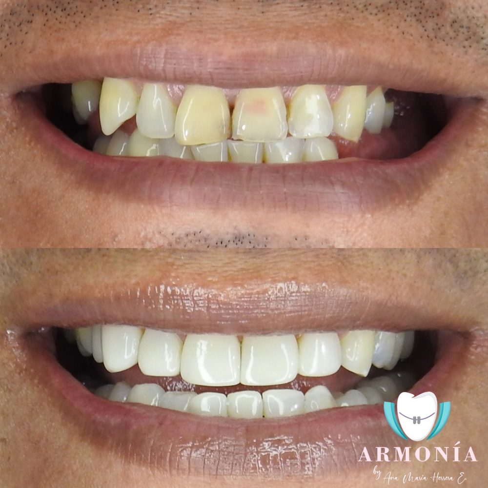 Caso real de estética dental en Armonía Neiva: antes y después del tratamiento