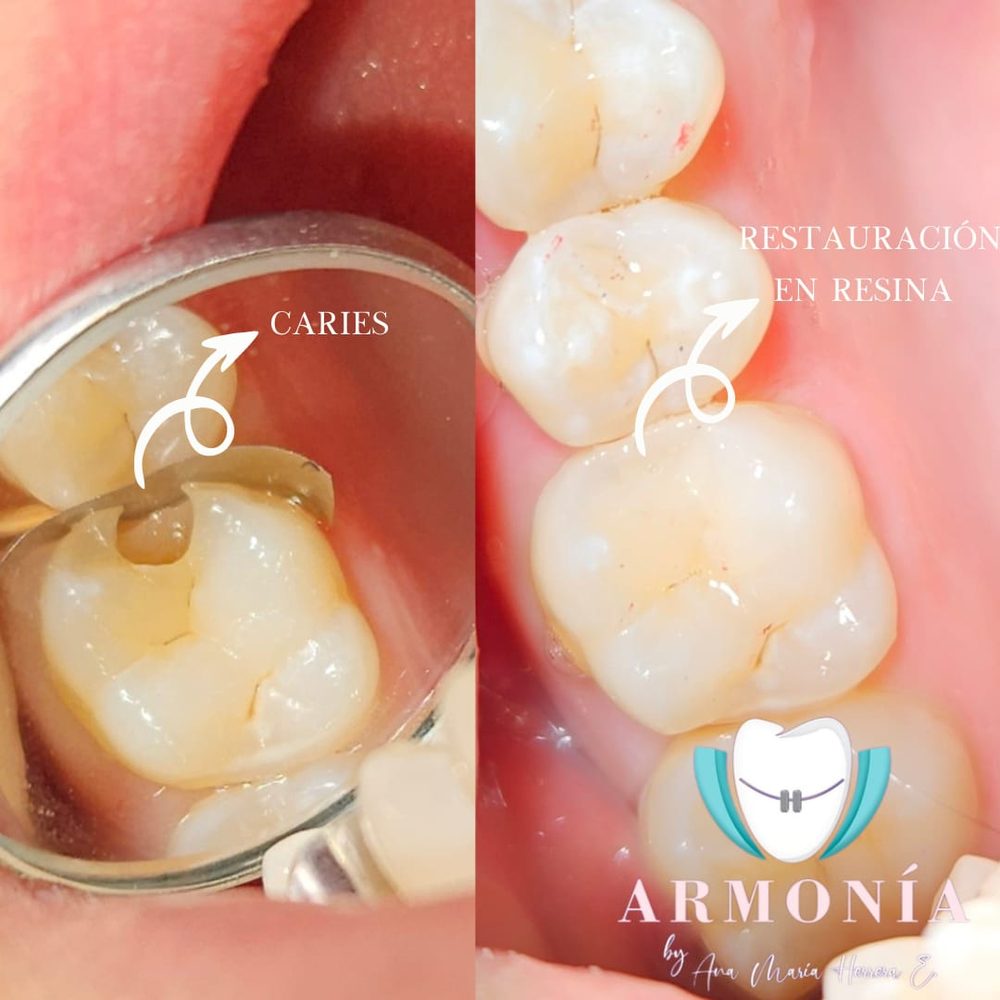 Caso real de operatoria dental en Armonía Neiva: caries y restauración en resina