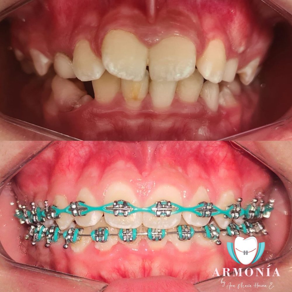 Caso real de ortodoncia en Armonía Neiva: antes y después del tratamiento con brackets